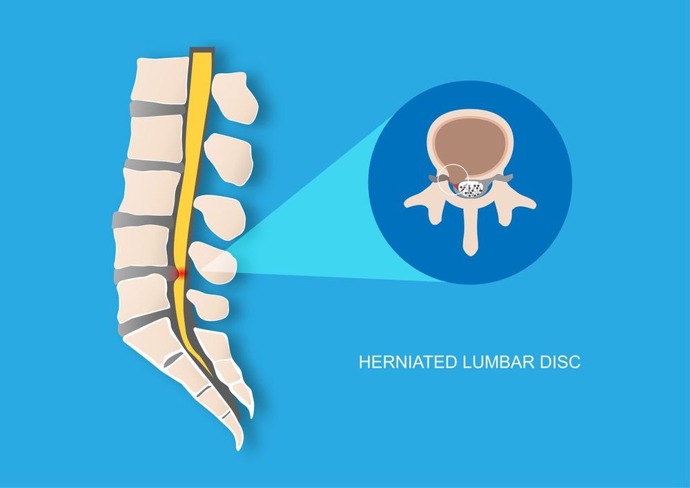 Illustration showing a herniated lumbar disk on a spine.